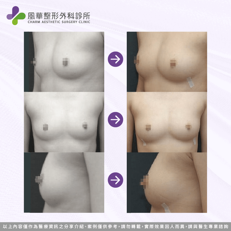 台北自體脂肪隆乳案例-台北自體脂肪隆乳推薦