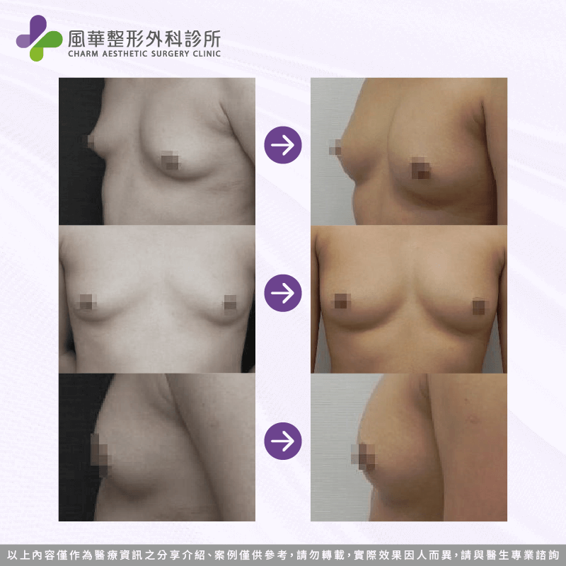 台北自體脂肪隆乳推薦-台北自體脂肪隆乳案例