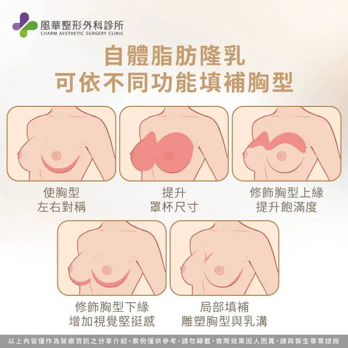 常見自體脂肪隆乳需求-自體脂肪隆乳維持多久