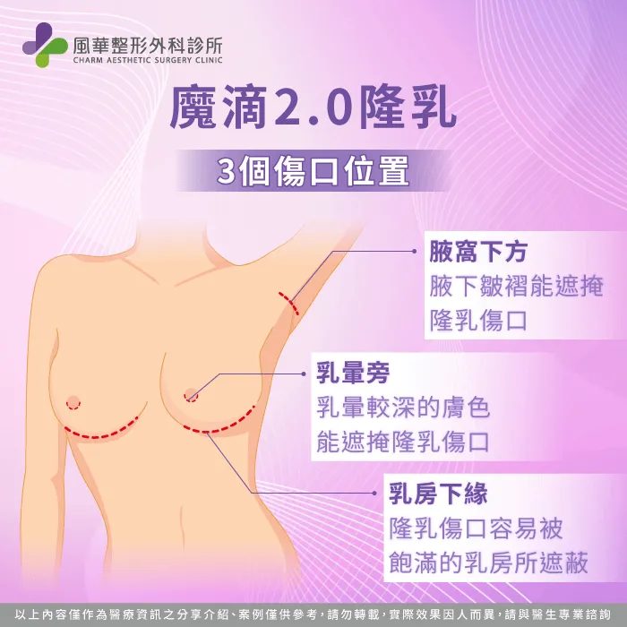 3種魔滴2.0隆乳傷口-魔滴2.0隆乳傷口位置