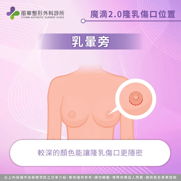 乳暈旁的切口位置-魔滴2.0隆乳傷口在哪